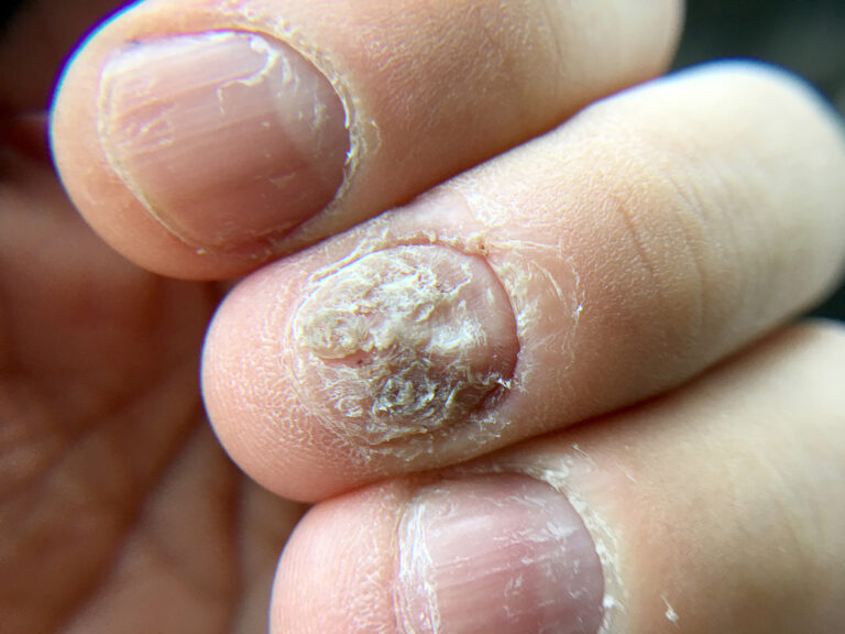 Big close up of fungus Infection on Nails Hand, Finger with onychomycosis, Fungal infection on nails