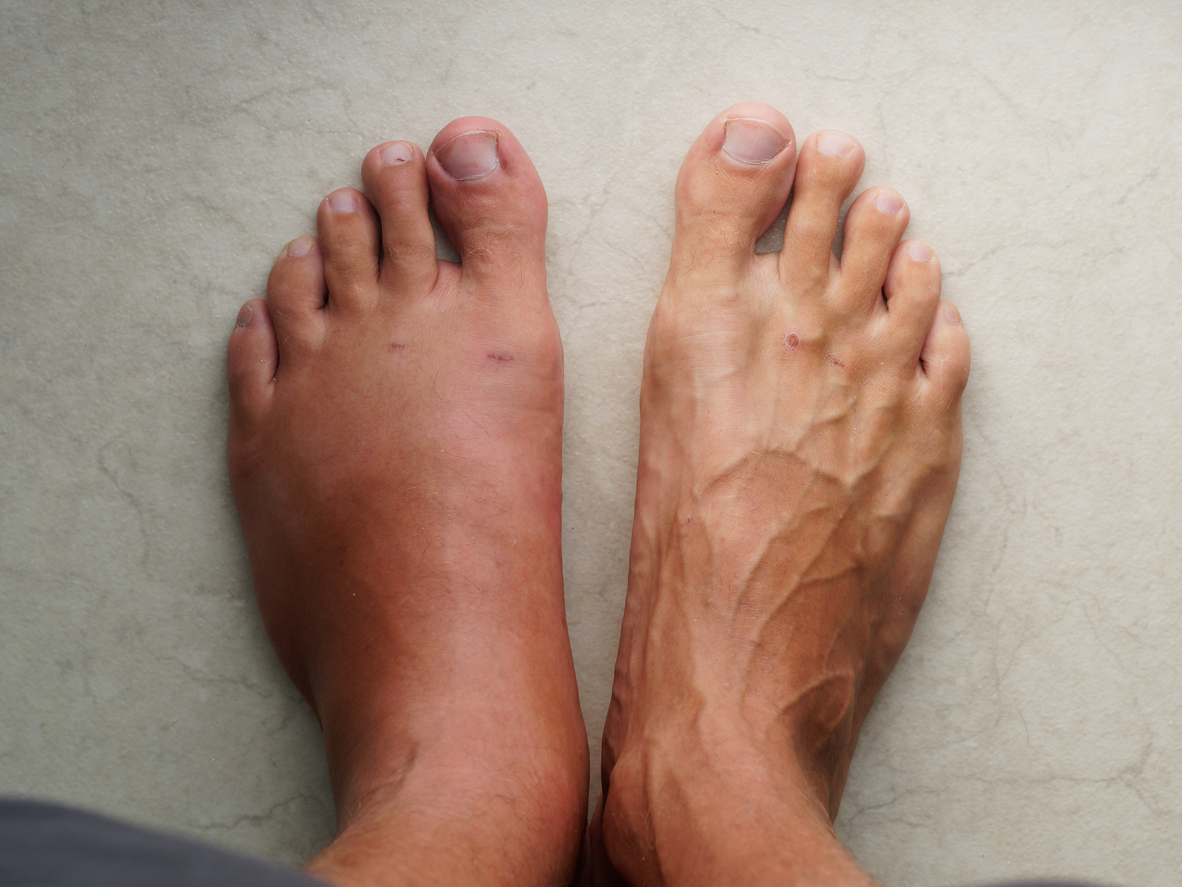 Swollen leg after a wasp bite